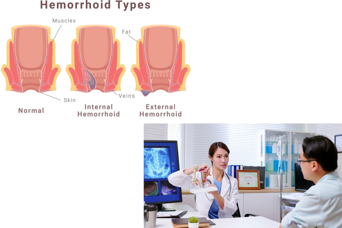 hemorrhoid treatment in Long Beach
