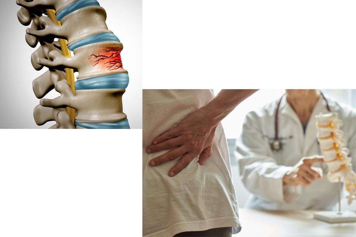 Spine Fracture