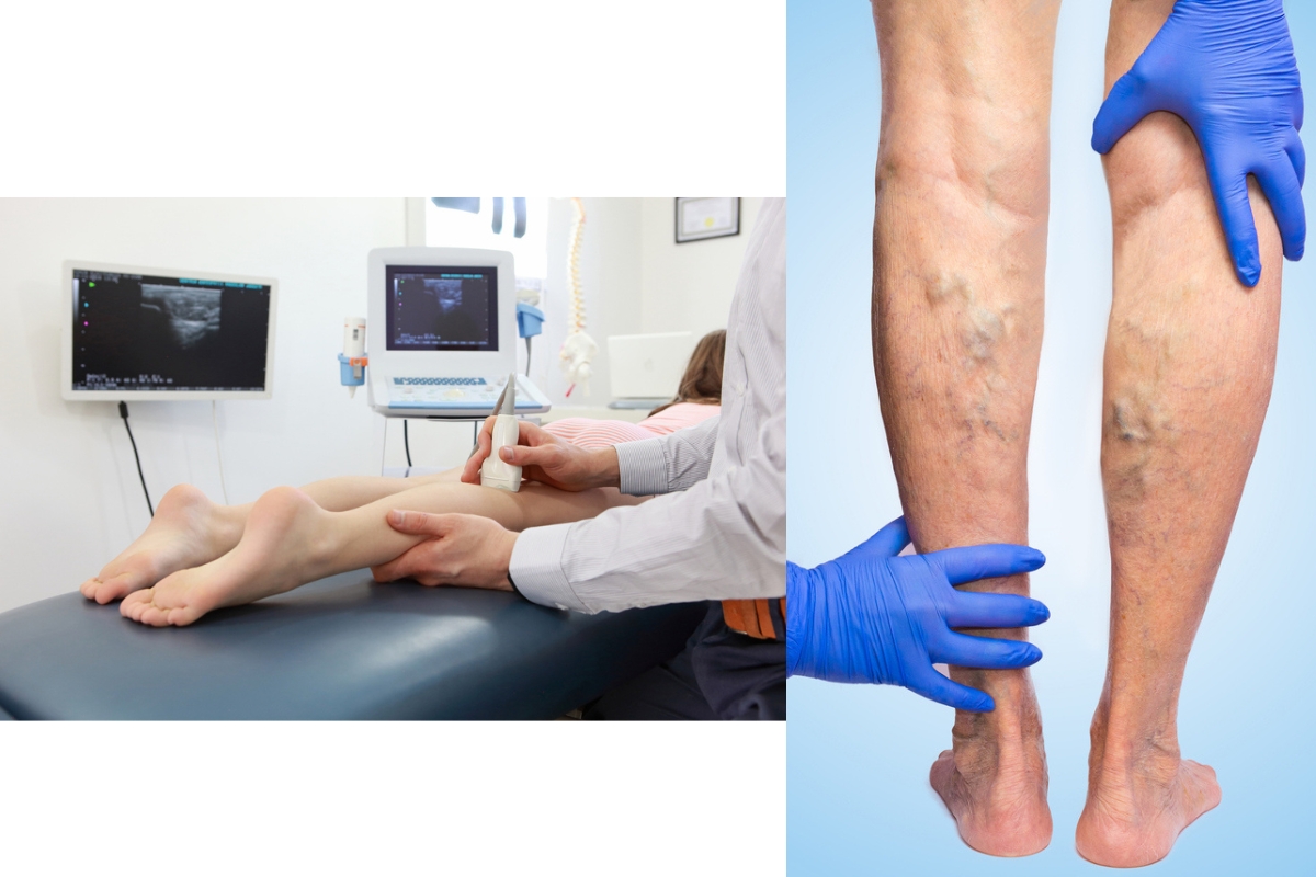 Varicose Veins